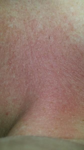 chest rash??? super itchy
