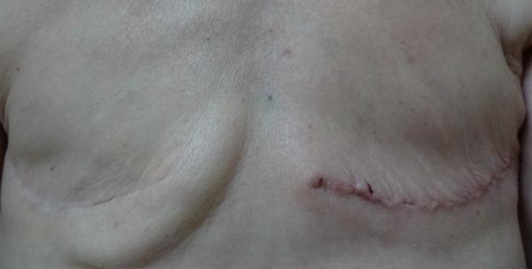 Zombie's  journey with breast cancer