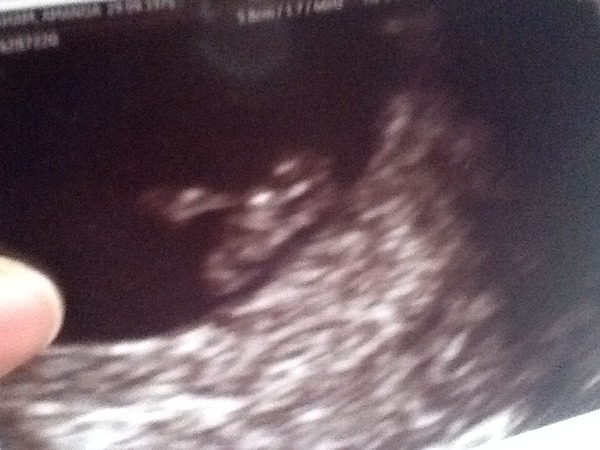 6 week scan pics