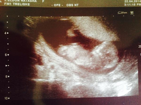Gender at 12 weeks scan