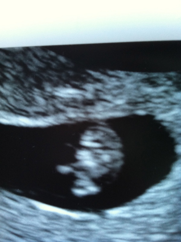 6 week scan pics