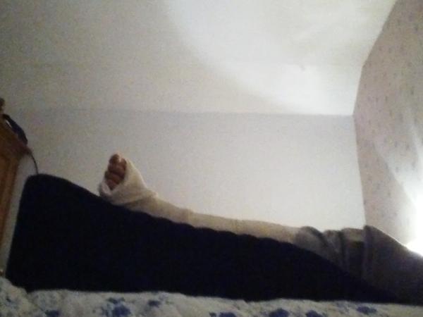 Broken leg - any tips?