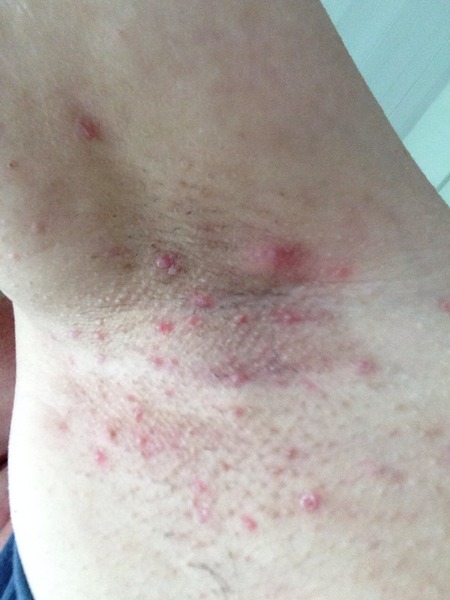 Anyone else with hydrentitis suppurativa?