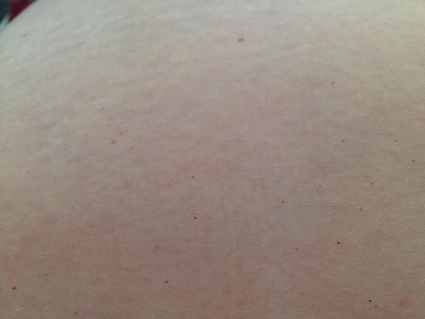 Spots/Rash on my bump