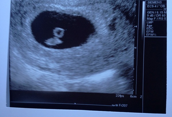 What to expect at early reassurance scan?