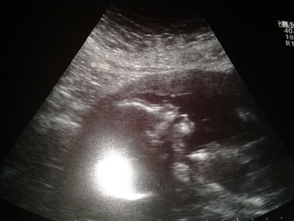 October 2014 - thread 6 - BLUE/PINK/YELLOW the finding out begins!!!