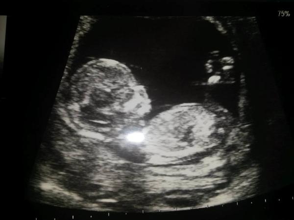 Gender at 12 weeks scan