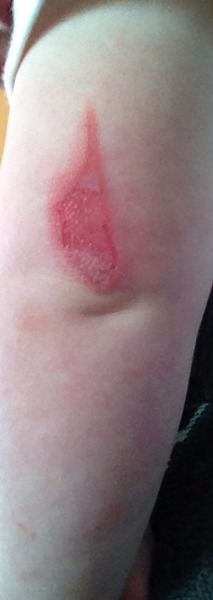 18 month old with burn.