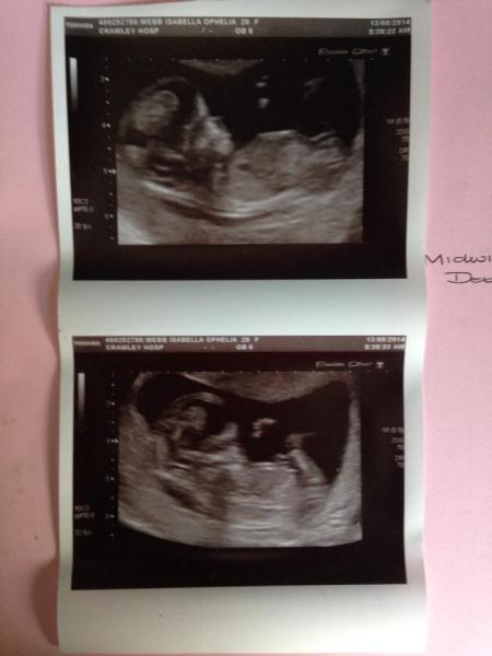 12 week scan
