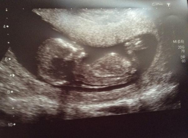 November 2014- thread 4- 12 week scans and blooming in the second trimester!