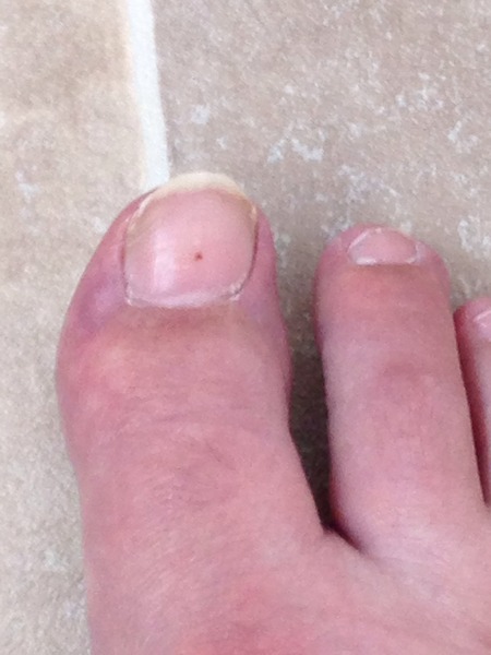 Possible mole on nail? Would you go to GP?