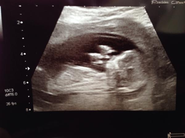 November 2014- thread 4- 12 week scans and blooming in the second trimester!