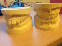 Twin block braces- should we persevere?