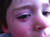 Chickenpox reassurance. Infected by eye?