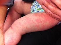 What to expect from allergy clinic appointment