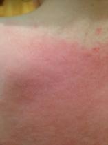 What's zerobase? Is it any good? Grass skin allergy