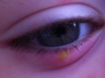 Chickenpox reassurance. Infected by eye?