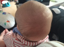Sorry, me and craniosynostosis again