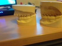 Twin block braces- should we persevere?