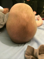 Sorry, me and craniosynostosis again