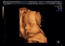 IVF Graduates - A place for pregnancy menkulling