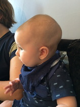 Sorry, me and craniosynostosis again