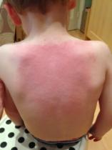 What's zerobase? Is it any good? Grass skin allergy