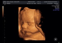 IVF Graduates - A place for pregnancy menkulling