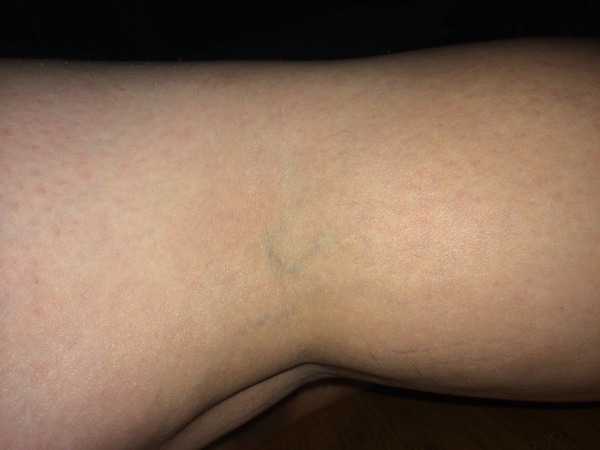 Could this be a varicose vein? (Sorry if gross)