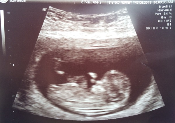 Morning sickness go away but don't come again another day.... Let's start glowing for all the right reasons! Jan 2015 thread 4...