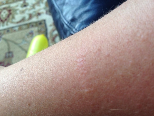 What could this rash be? Pic included.