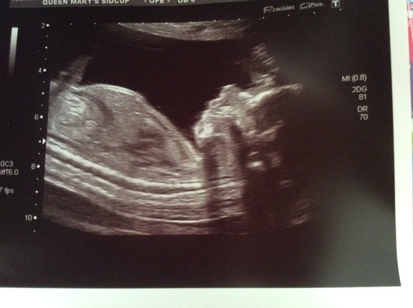 November 2014- Thread 6- Pink, blue or yellow? 20 week scans coming up for the rainbow collective