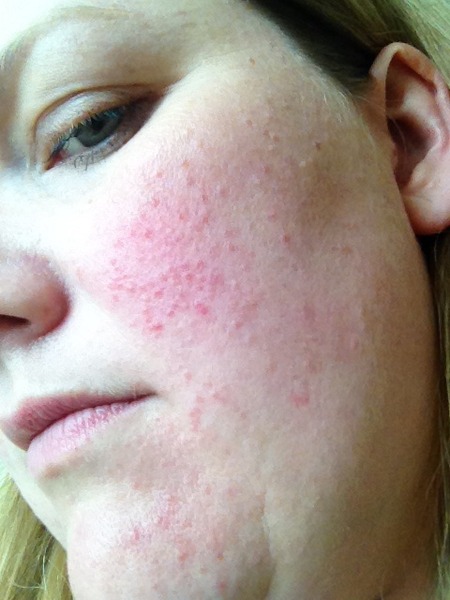 Skin erupted after miscarriage :-(