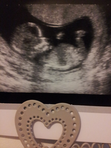 12/13 week dating scan - can you guess the gender? ?