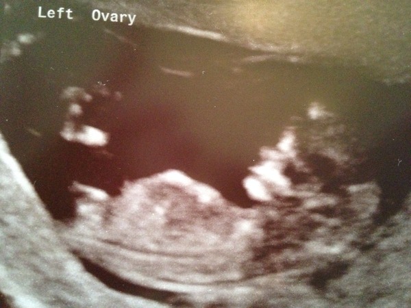 Pregnant after MC due December 14