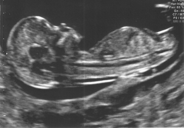 Pregnant after MC due December 14