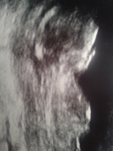 Pregnant after MC due December 14