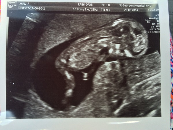 Morning sickness go away but don't come again another day.... Let's start glowing for all the right reasons! Jan 2015 thread 4...