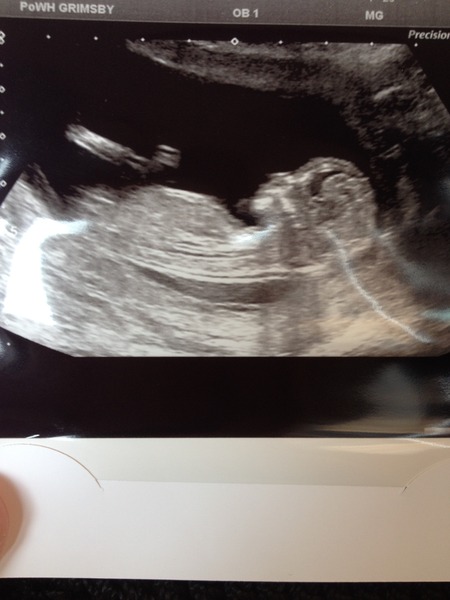 Pregnant after MC due December 14