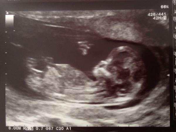 Morning sickness go away but don't come again another day.... Let's start glowing for all the right reasons! Jan 2015 thread 4...