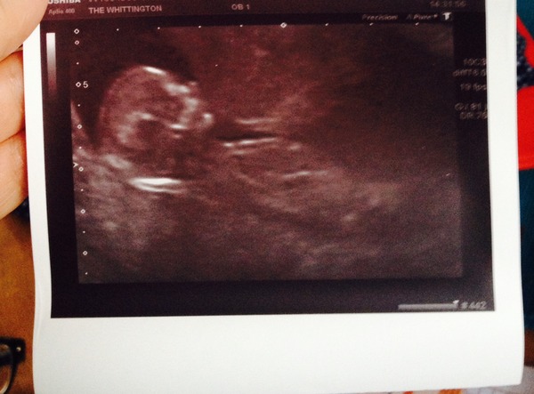 Pregnant after MC due December 14