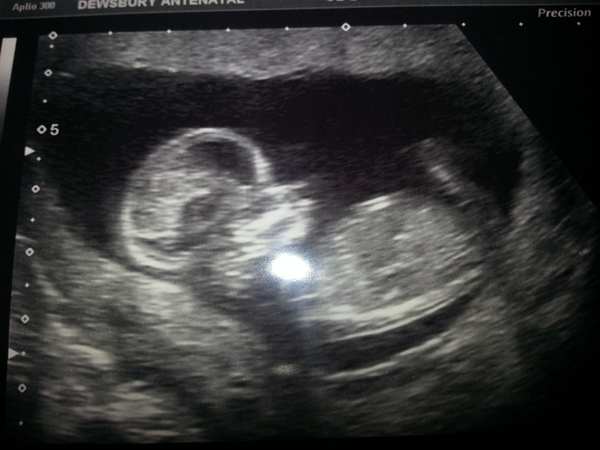 Leaving the first trimester behind and hopefully all the sickness and worry that has come with it. January 2015 thread #5