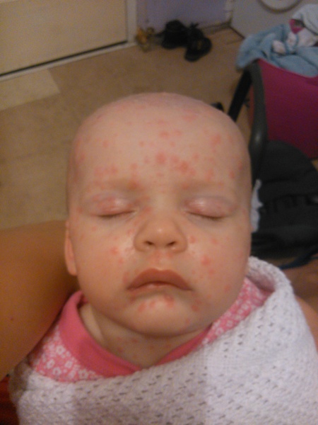 Blue feet and hands with chickenpox