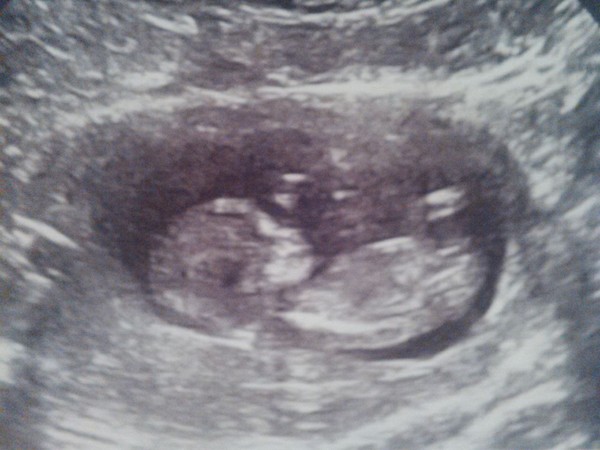 Morning sickness go away but don't come again another day.... Let's start glowing for all the right reasons! Jan 2015 thread 4...