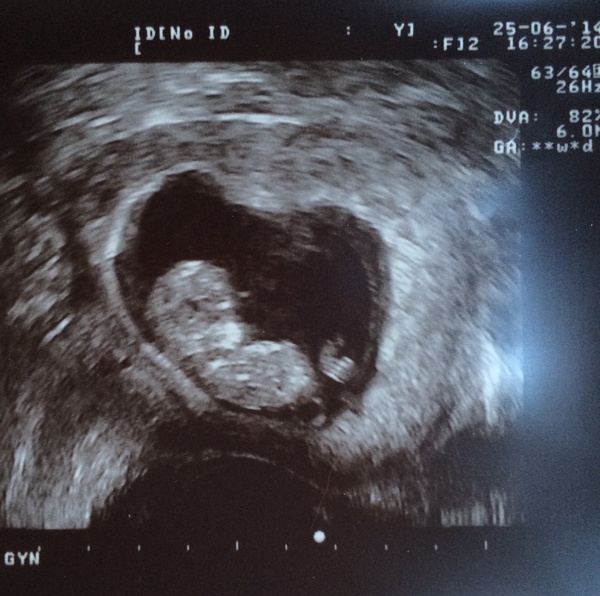 Leaving the first trimester behind and hopefully all the sickness and worry that has come with it. January 2015 thread #5