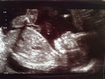 20 weeks gender scan unknown!!