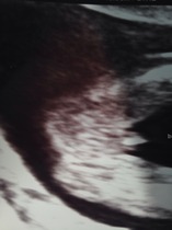 Pregnant after MC due December 14