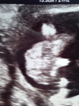 Pregnant after MC due December 14
