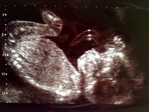 20 weeks gender scan unknown!!