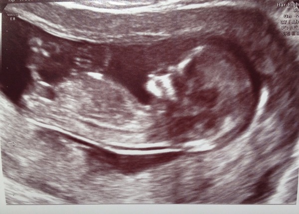 Leaving the first trimester behind and hopefully all the sickness and worry that has come with it. January 2015 thread #5